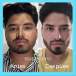 Bichectomía: antes y después