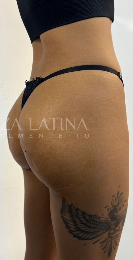 Endolyse en Glúteos - después